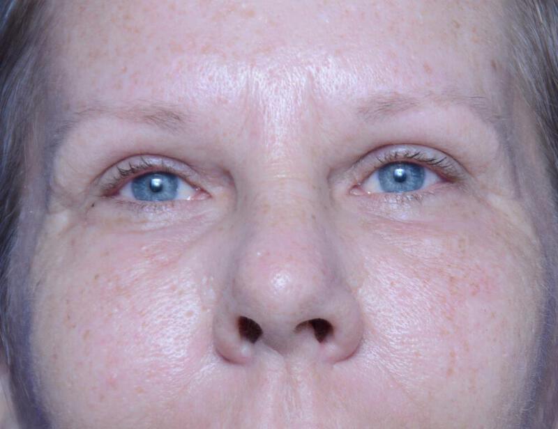 Upper Blepharoplasty Gallery Before & After Image