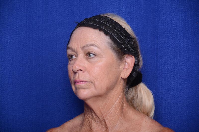 Upper Blepharoplasty Gallery Before & After Image