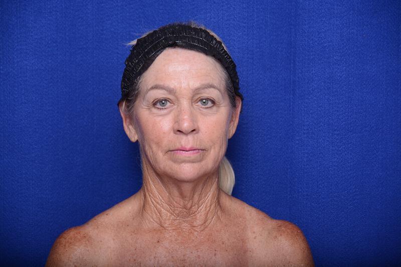 Upper Blepharoplasty Gallery Before & After Image