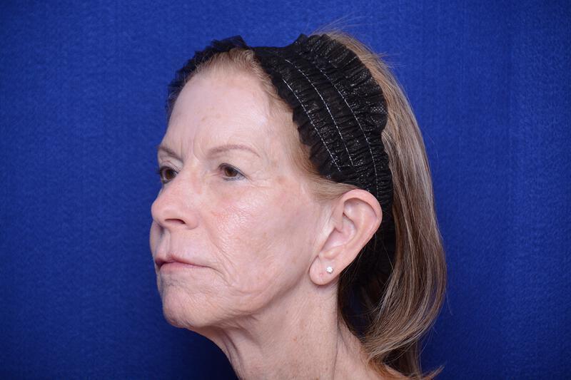 Upper Blepharoplasty Gallery Before & After Image