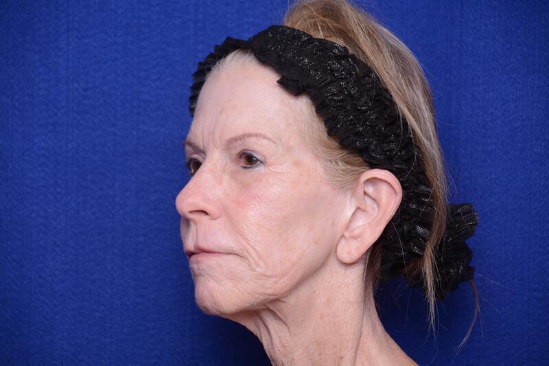 Upper Blepharoplasty Gallery Before & After Image