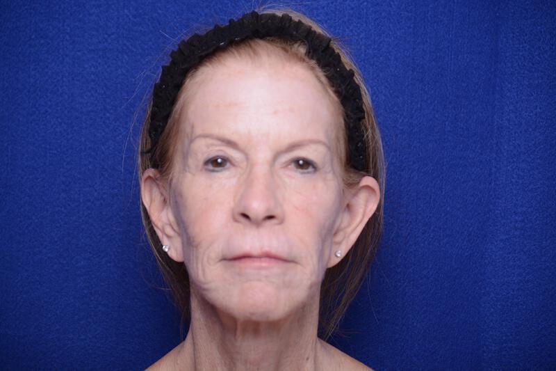 Upper Blepharoplasty Gallery Before & After Image