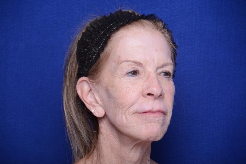 Upper Blepharoplasty Gallery Before & After Image