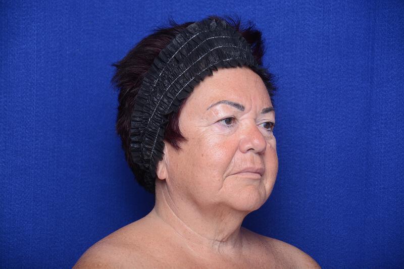 Upper Blepharoplasty Gallery Before & After Image