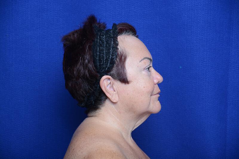 Upper Blepharoplasty Gallery Before & After Image