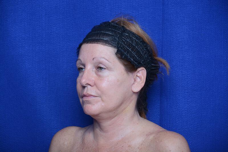 Upper Blepharoplasty Gallery Before & After Image