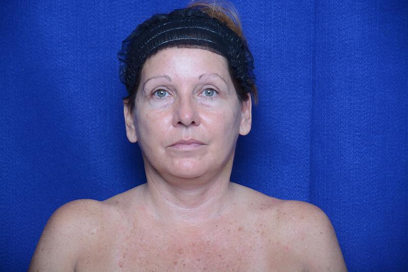 Upper Blepharoplasty Gallery Before & After Image