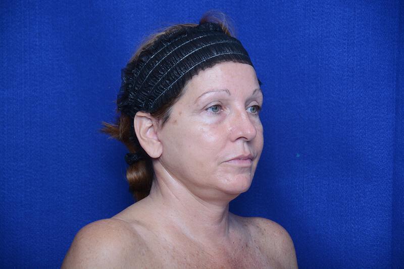 Upper Blepharoplasty Gallery Before & After Image