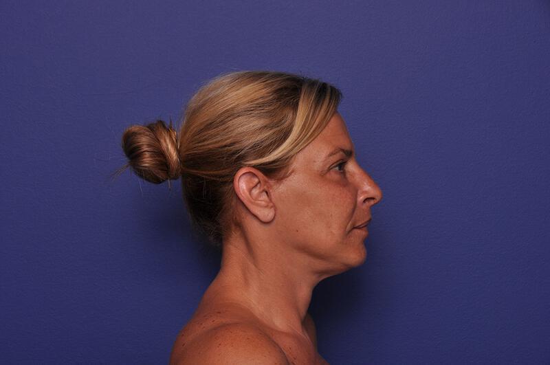 Upper Blepharoplasty Gallery Before & After Image