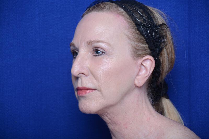 Upper Blepharoplasty Gallery Before & After Image