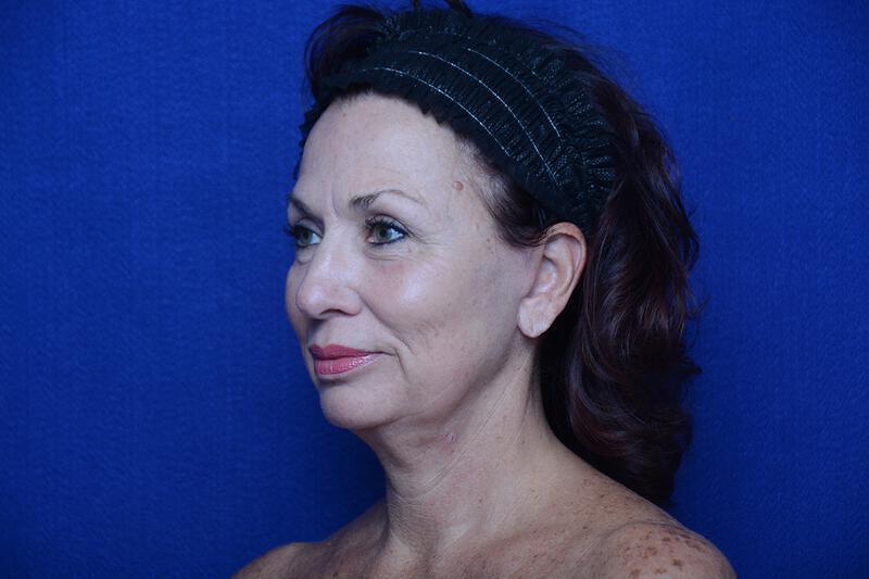 Upper Blepharoplasty Gallery Before & After Image