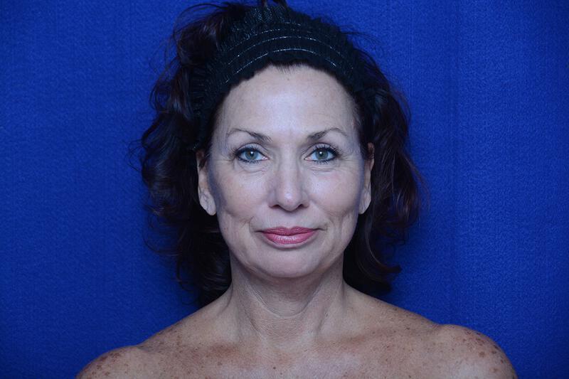 Upper Blepharoplasty Gallery Before & After Image