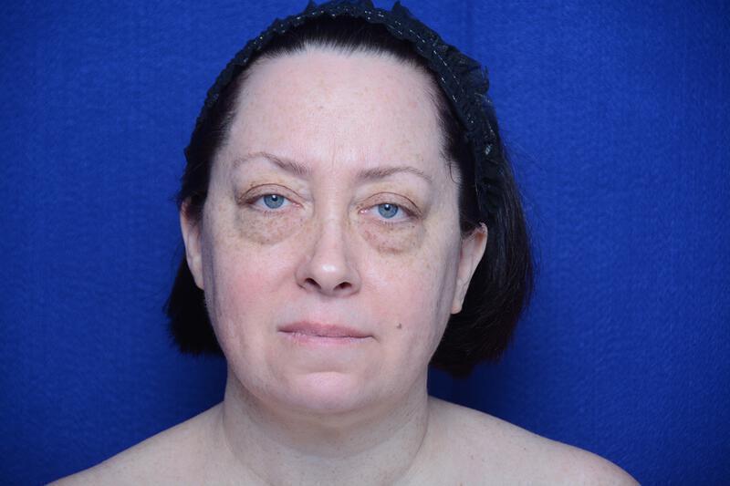 Upper Blepharoplasty Gallery Before & After Image